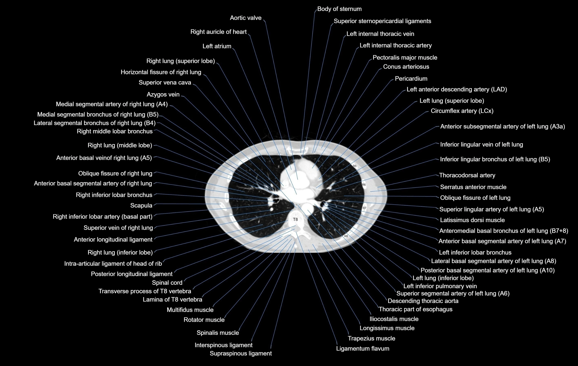 CT chest (thorax) labelled axial cross sectional anatomy radiology image-00067.webp